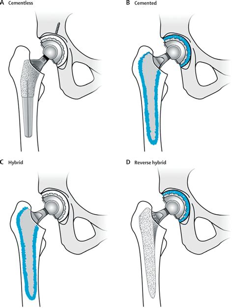 bearing surfaces in total hip arthroplasty ppt|Bearing Surfaces in Total Hip Arthroplasty .
